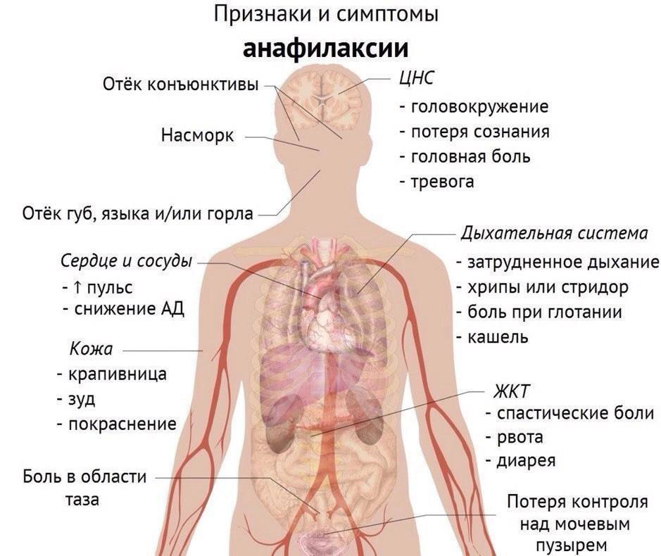 Экстренные меры при анафилактическом шоке: как спасти жизнь