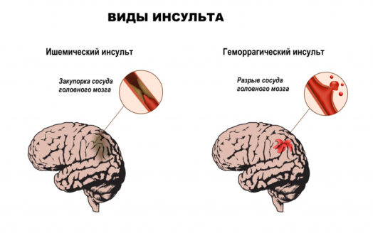 Первая помощь при инсульте: что нужно знать и как действовать правильно