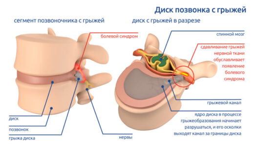 Можно ли избавиться от грыжи позвоночника без операции: факты и мифы